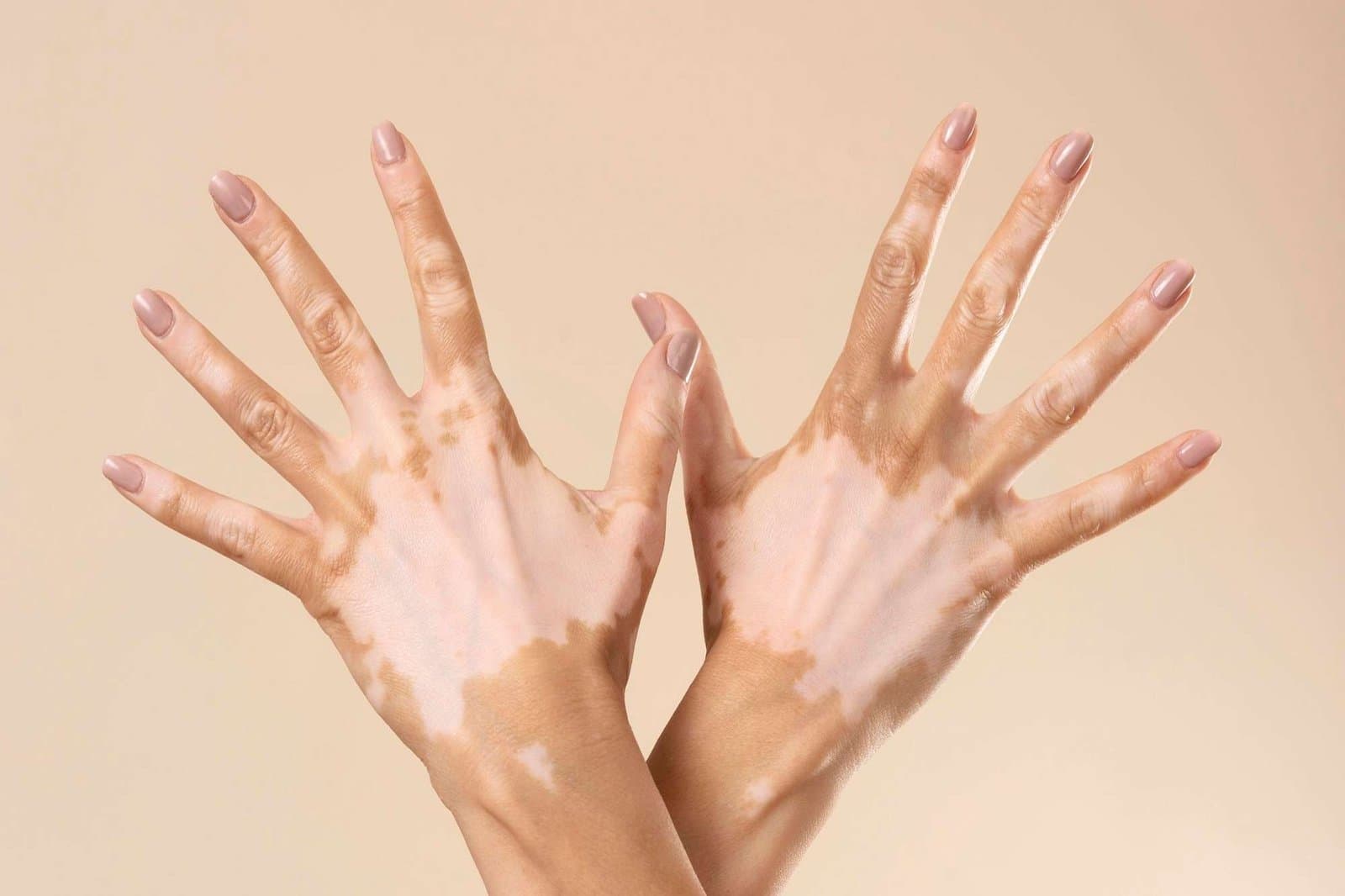 "Phototherapy for Vitiligo: Harnessing Light for Skin Health"