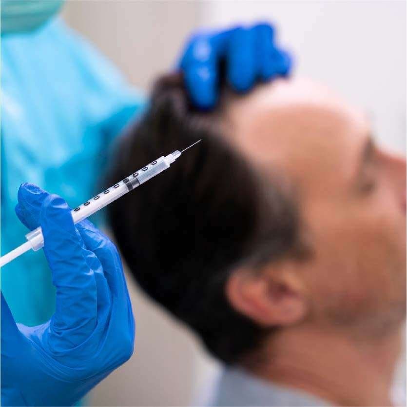PRP for Hair
