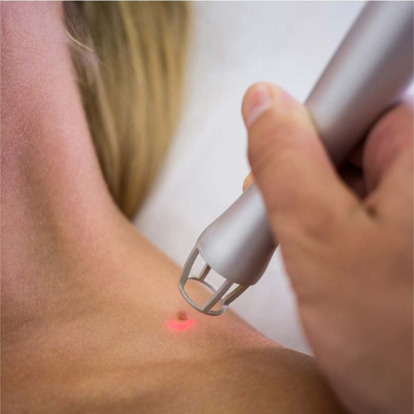 Best Mole Removal Treatment in Indore