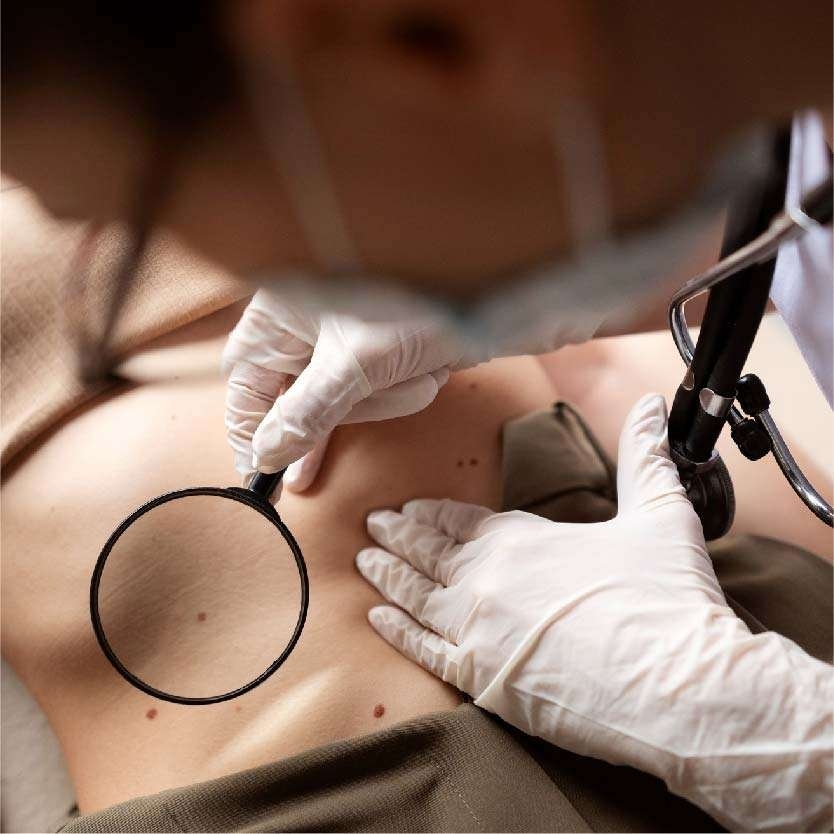 Best Scar Revision Treatment in Indore