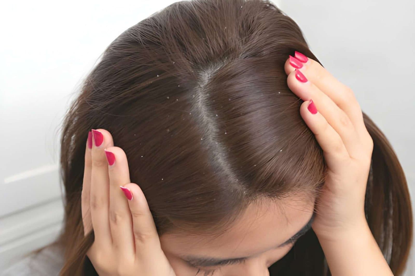 Dandruff in Humid Weather – Causes & Solutions